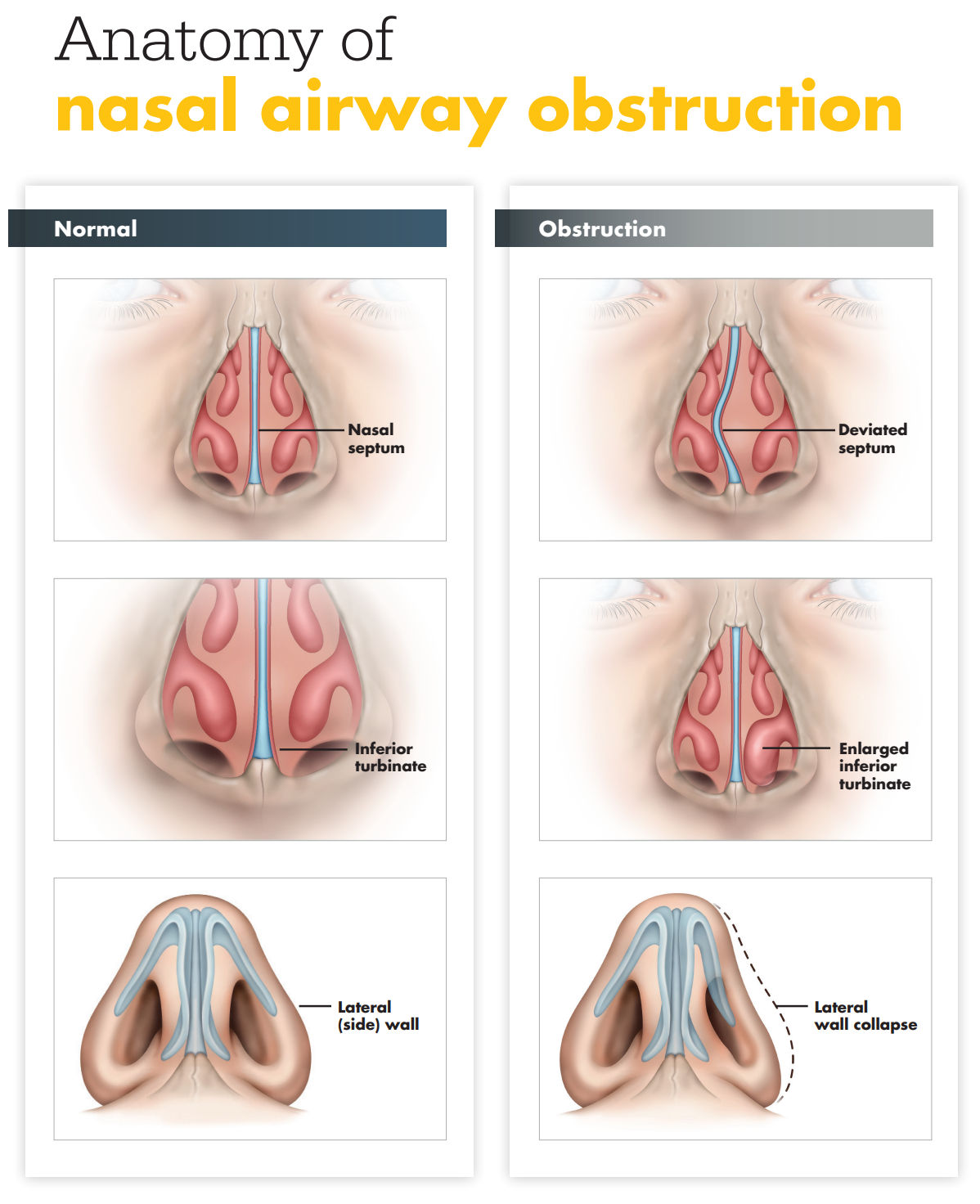 nasal valve collapse